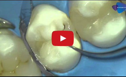 DM_il dentista moderno_odontoiatria restaurativa