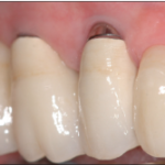 Gestione dei tessuti perimplantari gestione tessuti perimplantari