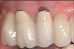 gestione tessuti perimplantari