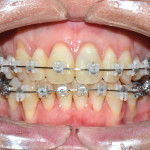 Corticotomie a scopo ortodontico: protocolli clinici e revisione della letteratura