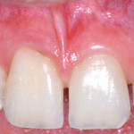 Management conservativo-parodontale di un riassorbimento cervicale esterno idiopatico in zona estetica