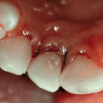 Frattura corono-radicolare: gestione di un caso clinico