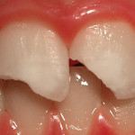 3. I laser in traumatologia dentale