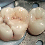 Terapia della polpa vitale: vantaggi dell’utilizzo della tecnologia laser