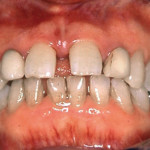 Trattamento ortodontico nella terza età. Case report