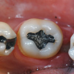 Sensibilità post-operativa e risultati clinici a un anno di restauri di II classe eseguiti con Kalore