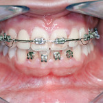 L’espansione ossea nella riabilitazione implantare di monoedentulie a carico immediato del mascellare superiore. Case report