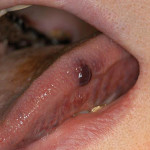 Terapie chirurgiche laser assistite negli emangiomi capillari del cavo orale