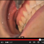 Alternative alla classica anestesia tronculare del nervo alveolare inferiore Alternative alla classica anestesia tronculare del nervo alveolare inferiore 2