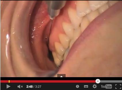 Alternative alla classica anestesia tronculare del nervo alveolare inferiore 2