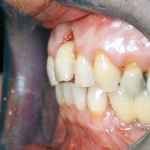 Rigenerazione ossea orizzontale e gestione dei tessuti molli in una zona estetica