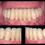 Anestesia generale in odontoiatria. Protocolli operativi per il trattamento in singola seduta del paziente non collaborante