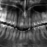 La chirurgia degli ottavi: dalla programmazione dell’intervento alla gestione delle complicanze