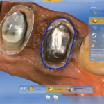 L’evoluzione dei restauri CAD-CAM Chairside nell’odontoiatria moderna DM_il dentista moderno_CAD-CAM chairside_odontoiatria 1