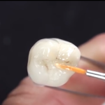 Edentulia singola: work-flow della riabilitazione con tecnologia CAD-CAM chairside DM_il dentista moderno_CAD-CAM chairside_odontoiatria 2