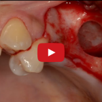 Pro e contro dell’uso degli strumenti ad ultrasuoni in chirurgia orale DM_il dentista moderno_Gli strumenti ad ultrasuoni in parodontologia implantologia e chirurgia orale