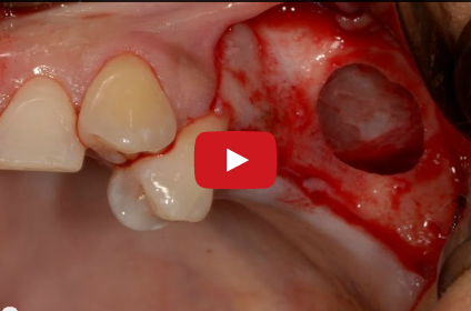 DM_il dentista moderno_Gli strumenti ad ultrasuoni in parodontologia implantologia e chirurgia orale