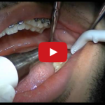 Gli strumenti piezoelettrici in parodontologia, implantologia e chirurgia orale DM_il dentista moderno_Gli strumenti piezoelettrici in parodontologia implantologia e chirurgia orale