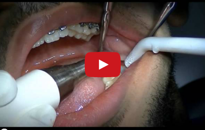 DM_il dentista moderno_Gli strumenti piezoelettrici in parodontologia implantologia e chirurgia orale