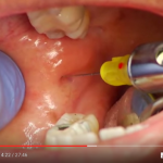 Anestesia: raccomandazioni sull’uso del vasocostrittore in odontoiatria DM_il dentista moderno_dolore_anestesia tronculare del nervo alveolare inferiore odontoiatria_vasocostrittore in odontoiatria