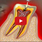 Dalla carie alla devitalizzazione passando per la polpa dentale DM_il dentista moderno_carie_devitalizzazione_polpa dentale