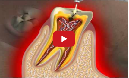 DM_il dentista moderno_carie_devitalizzazione_polpa dentale