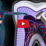 Pulpite reversibile o pulpite irreversibile? Conservativa o endodonzia? DM_il dentista moderno_carie_devitalizzazione_polpa dentale_conservativa_endodonzia_pulpite reversibile_pulpite irreversibile