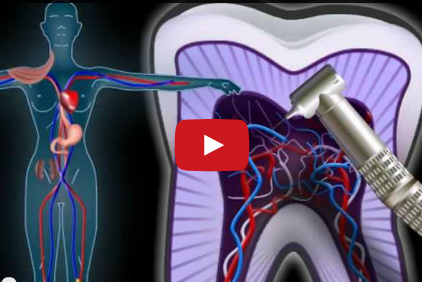 DM_il dentista moderno_carie_devitalizzazione_polpa dentale_conservativa_endodonzia_pulpite reversibile_pulpite irreversibile