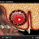 Classificazioni e inquadramento delle lesioni cistiche DM_il dentista moderno_classificazione delle lesioni cistiche_cisti ossea solitaria