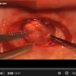 Cisti dei mascellari: diagnosi e trattamento DM_il dentista moderno_diagnosi e trattamento delle cisti dei mascellari