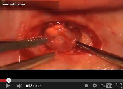 DM_il dentista moderno_diagnosi e trattamento delle cisti dei mascellari