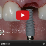 Criteri per scegliere il posizionamento di impianti a carico immediato DM_il dentista moderno_implanti a carico immediato