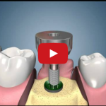 Dal protocollo Branemark all’implantologia a carico immediato DM_il dentista moderno_implantologia a carico immediato_2 stages