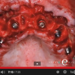 Quando scegliere l’implantologia a carico immediato DM_il dentista moderno_implantologia a carico immediato_QUANDO