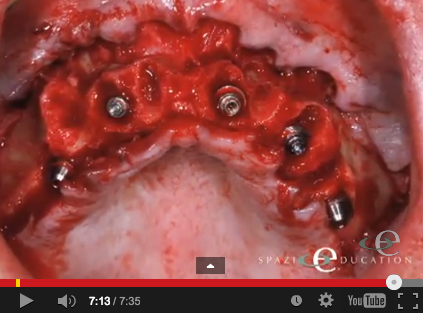 DM_il dentista moderno_implantologia a carico immediato_QUANDO