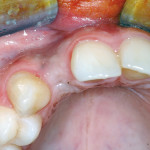 La rigenerazione ossea guidata (GBR) a scopo implantare