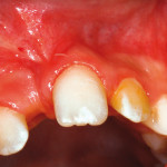 Ectopia e dilacerazione radicolare di un incisivo centrale permanente dovute ad avulsione traumatica di dente deciduo