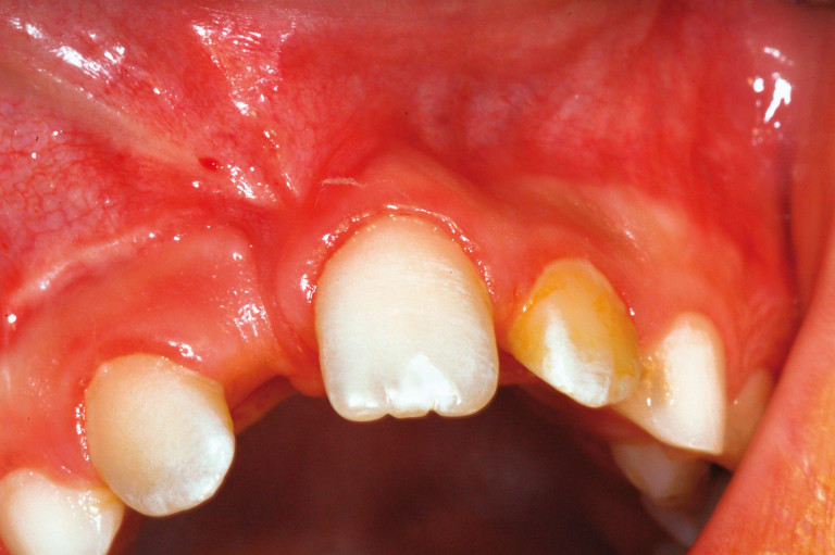 Ectopia e dilacerazione radicolare di un incisivo centrale permanente dovute ad avulsione traumatica  di dente deciduo