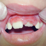 Odontoiatria preventiva, riabilitativa e funzionale nei pazienti con bisogni speciali