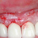 La prognosi in endodonzia chirurgica: revisione della letteratura