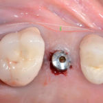 Proprietà e caratteristiche delle superfici implantari macchinate e ruvide a confronto