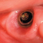 Estrarre o conservare l’elemento dentario? Il ruolo della chirurgia endodontica