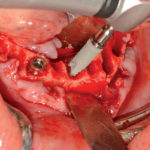 Come ottenere una stabilità primaria predicibile