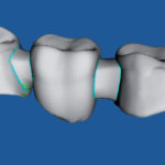 Dental FEA, il CAE in odontoiatria