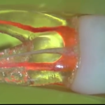 Endodonzia e nuovi strumenti: Protaper Next e Pathfile DM_il dentista moderno_endodonzia_ pathfile_protaper next