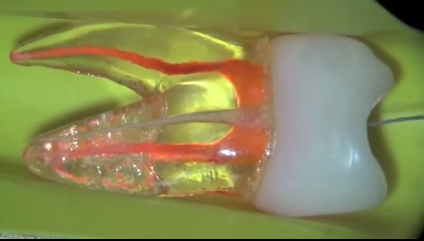 DM_il dentista moderno_endodonzia_ pathfile_protaper next