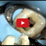 Endodonzia: il sistema di otturazione canalare Thermafil® DM_il dentista moderno_endodonzia_terapia canalare_Thermafil