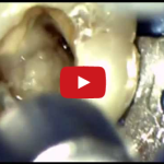 Problemi e soluzioni per l’utilizzo del Thermafil® in endodonzia DM_il dentista moderno_endodonzia_terapia canalare_Thermafil 2