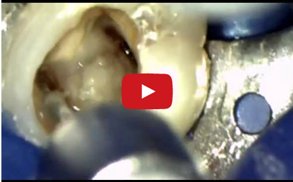 DM_il dentista moderno_endodonzia_terapia canalare_Thermafil 2