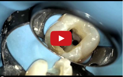 DM_il dentista moderno_endodonzia_terapia canalare_Thermafil